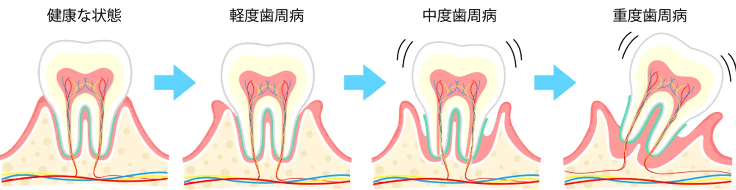 歯周病の進行過程