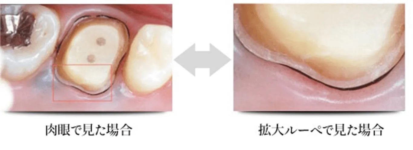 医療用拡大スコープを使用した場合の見え方