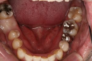 下の奥歯のインプラント（１本）　３０代男性のビフォーアフター画像