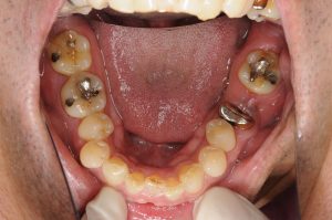 下の奥歯　インプラント（１本）　５０代男性のビフォーアフター画像