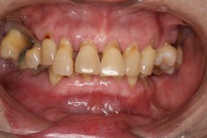 全額にわたる歯周病の方へのインプラント処置　５０代女性のビフォーアフター画像