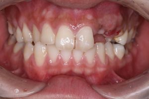 交通事故による歯の喪失　20代男性のビフォーアフター画像