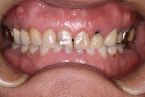 奥歯が歯根破折で噛めない　５０代男性のビフォーアフター画像