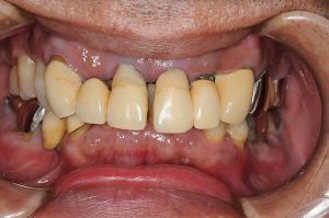 全額にわたる歯周病で噛めない　　　５０代男性のビフォーアフター画像