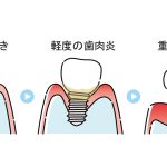 広島県府中市のインプラント治療後のケア方法｜長持ちさせるために毎日できること5選